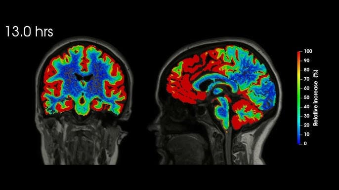 Sleep Deprivation Triggers Neuronal Self-Destruction: The Hidden Crisis Within Our Minds
